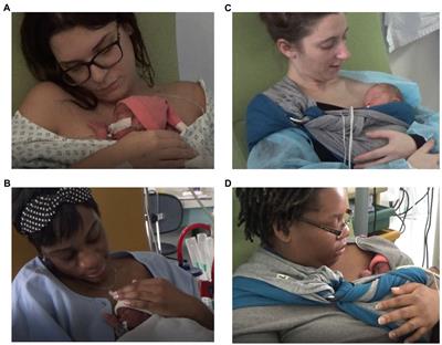 Skin-to-skin SDF positioning: The key to intersubjective intimacy between mother and very preterm newborn—A pilot matched-pair case-control study